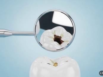 Große Füllung oder CEREC-Krone? Entscheidungshilfe für Patienten in Bad Dürkheim