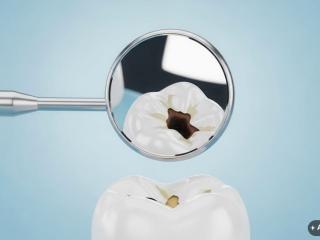 Große Füllung oder CEREC-Krone? Entscheidungshilfe für Patienten in Bad Dürkheim